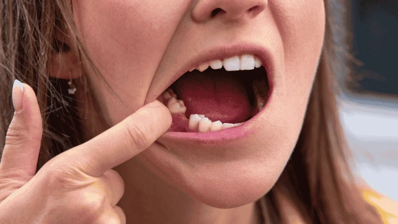 Missing tooth untreated consequences