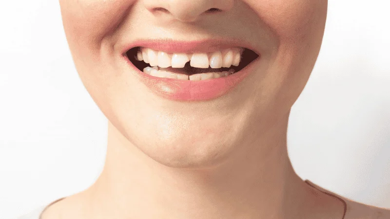 broken tooth beyond repair treatment