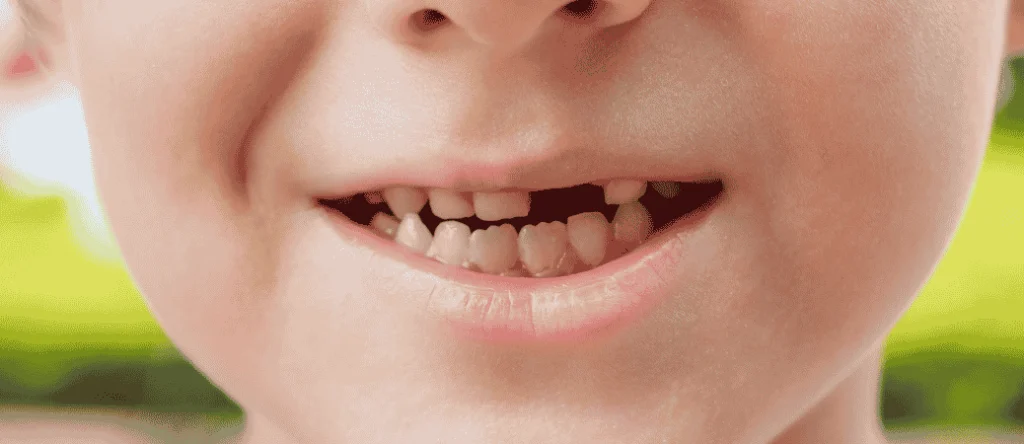 consequences of missing teeth