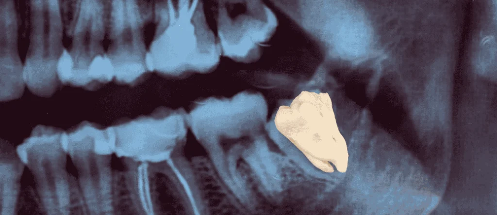 when is tooth extraction necessary